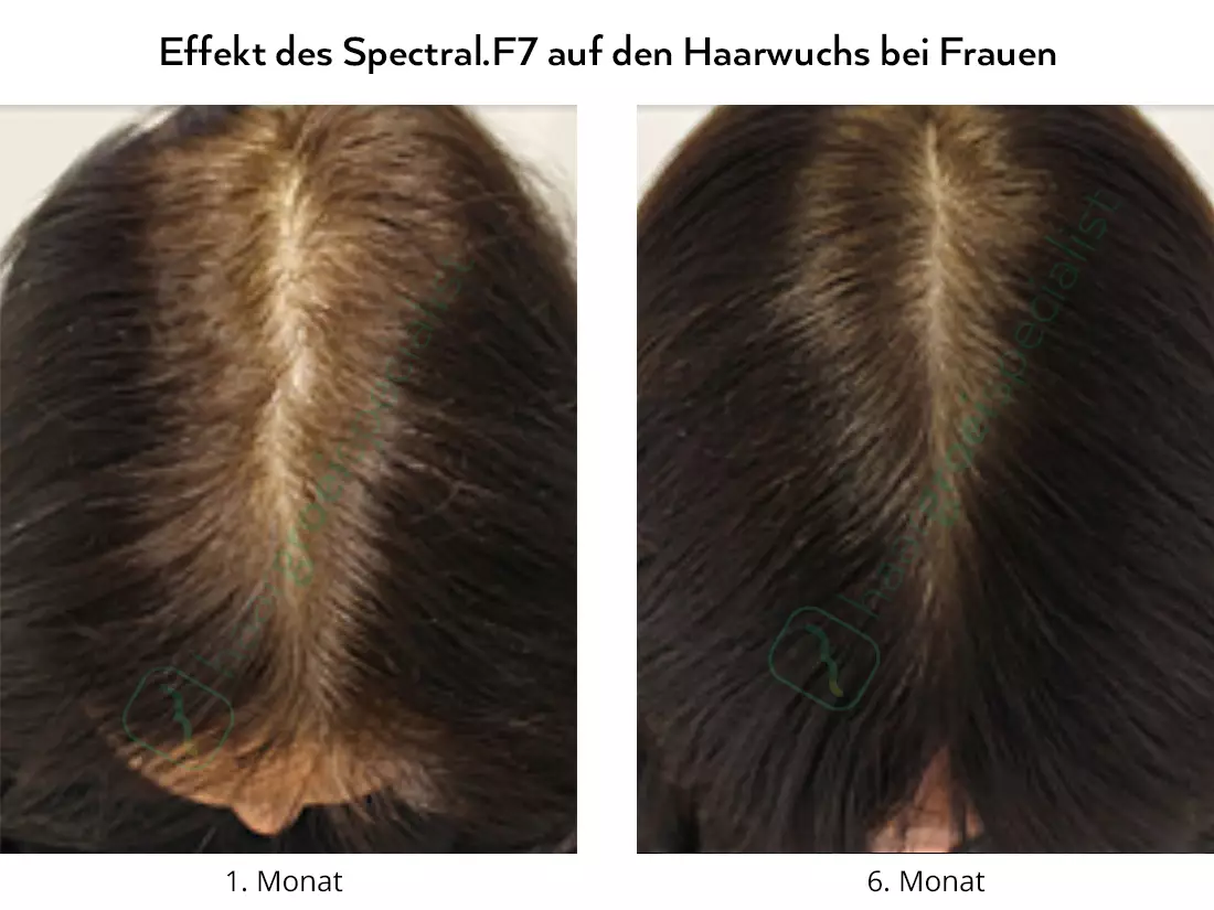Effekt des Spectral.F7 auf den Haarwuchs bei Frauen