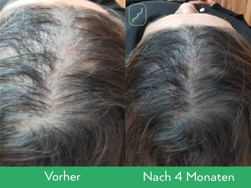 Neofollics Anti-Grau Haartabletten Ergebnisse Frau, nach 4 Monaten