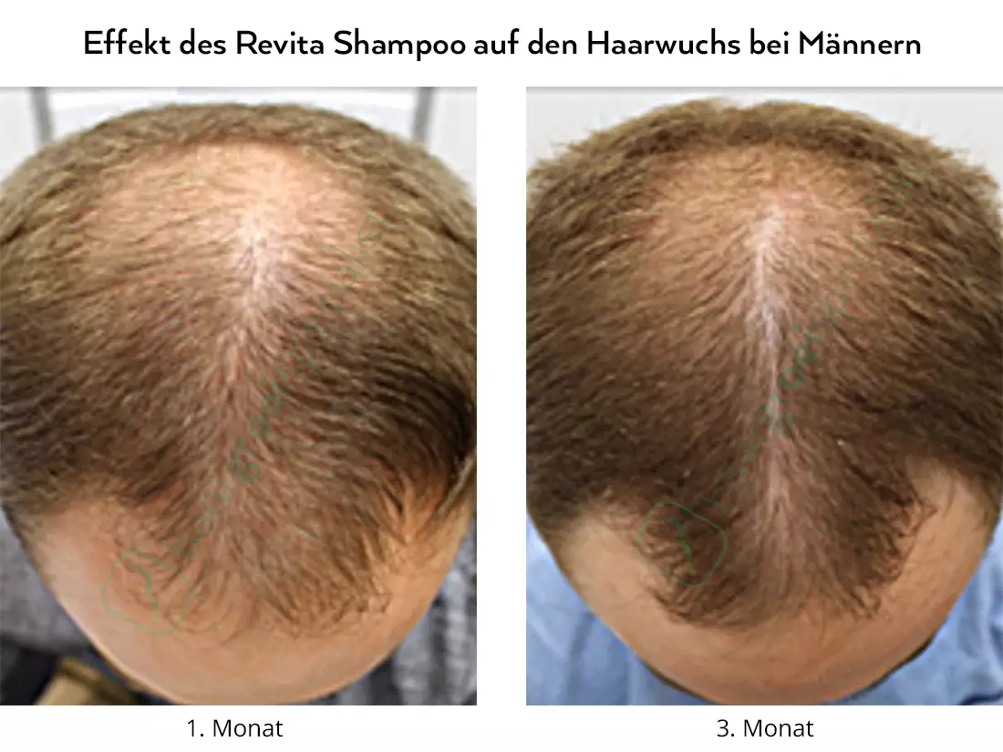 Effekt des Revita Shampoo auf den Haarwuchs bei Männern