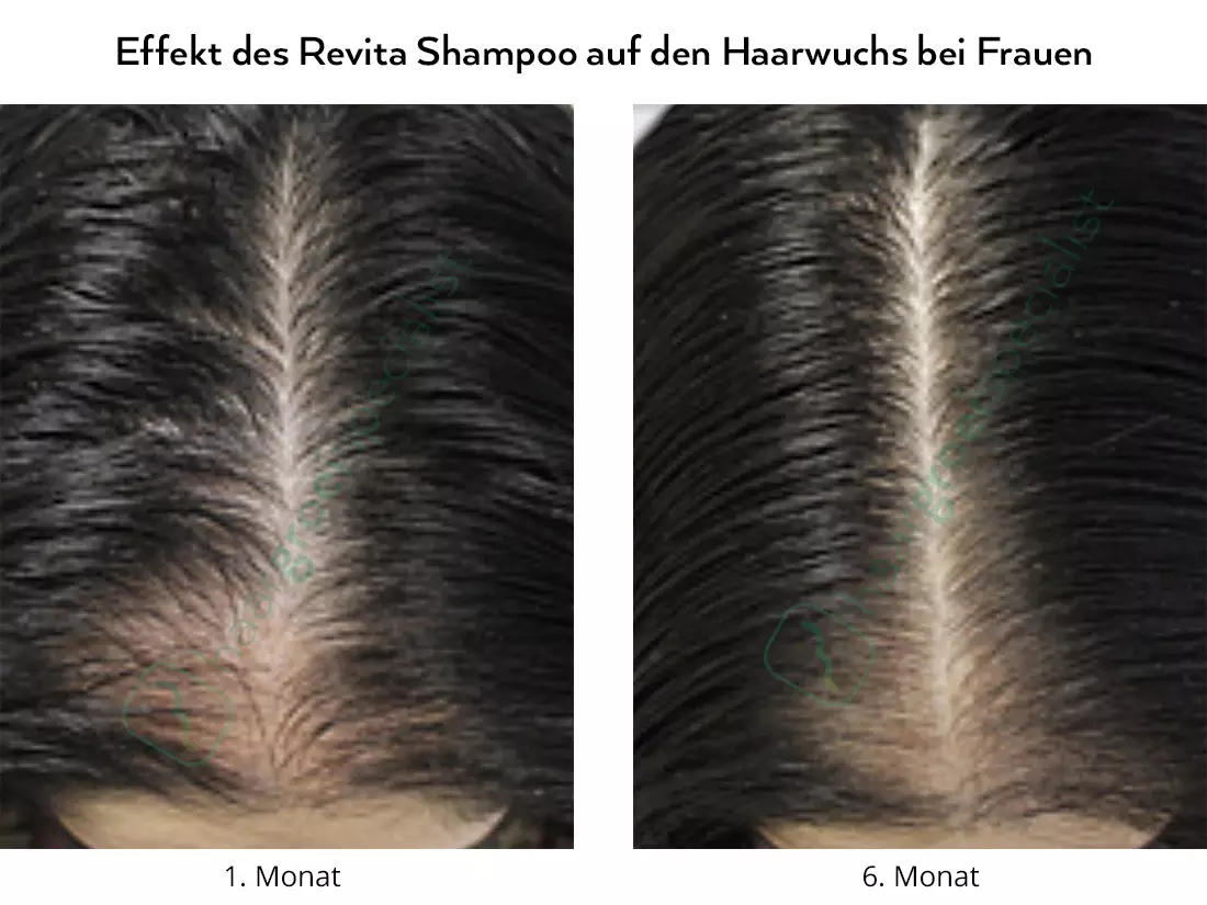 Effekt des Revita Shampoo auf den Haarwuchs bei Frauen