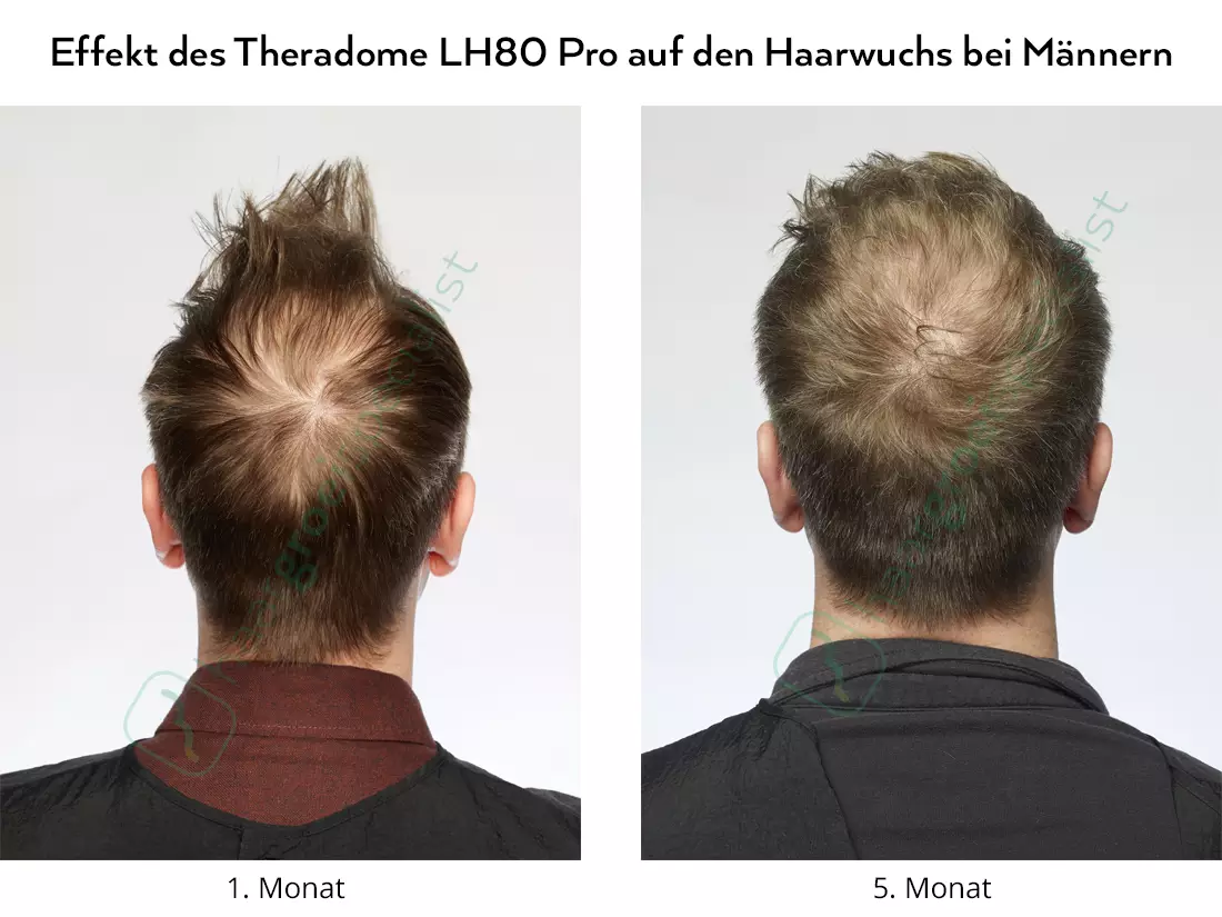 Effekt des Theradome LH80 Pro auf den Haarwuchs bei Männern