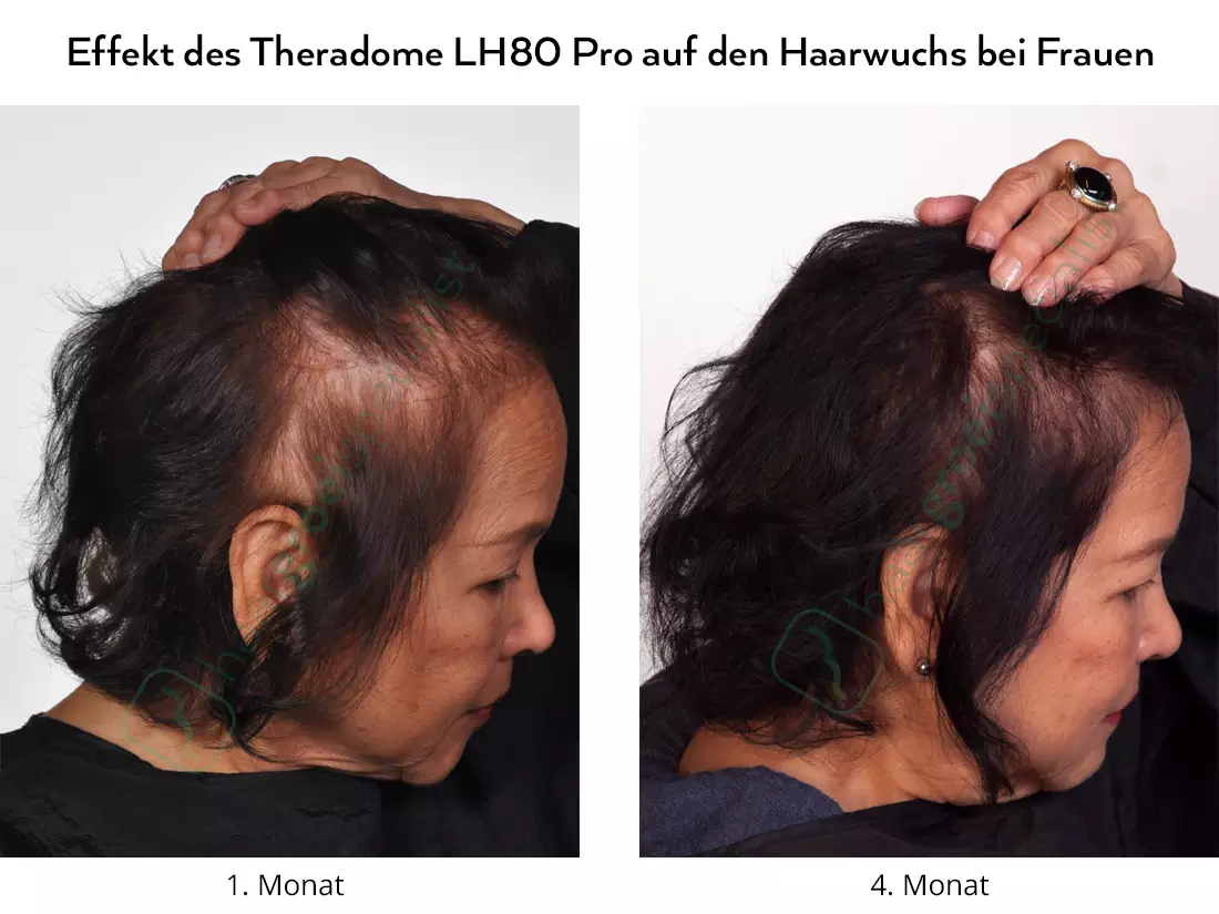 Effekt des Theradome LH80 Pro auf den Haarwuchs bei Frauen